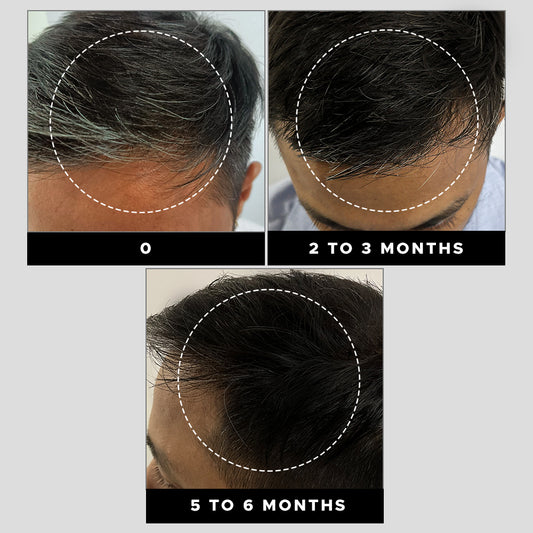 grey-hair-remedy-kit