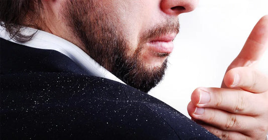 How to Get Rid of Dandruff & Flakes - Hair Care Tips For Men