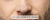 Blackheads Treatment for Men