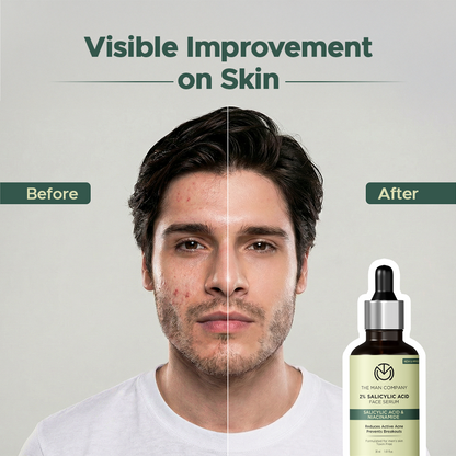 2% Salicylic Acid | Anti-Acne Face Serum